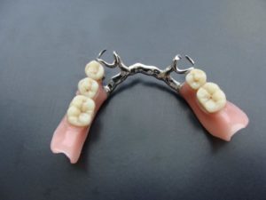 Частичный пластиночный протез